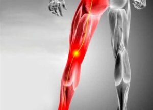 الحجامة ل عرق النساء و الولادة