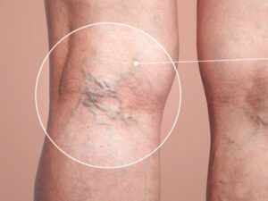 فوائد الحجامة لدوالي الساقين