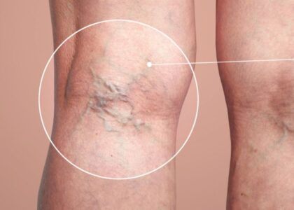 فوائد الحجامة لدوالي الساقين