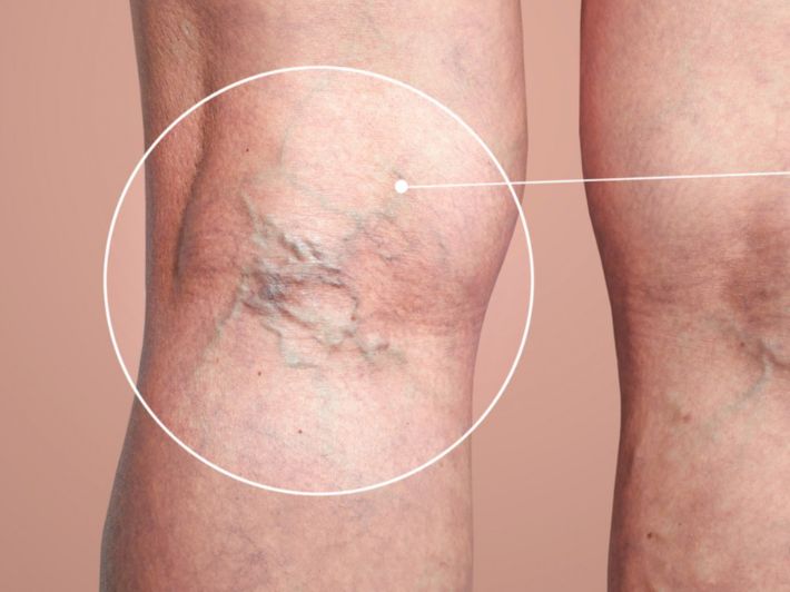 فوائد الحجامة لدوالي الساقين